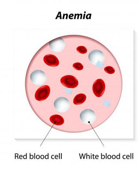 Anaemia During Pregnancy