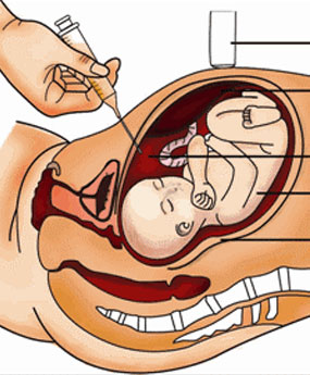 Amniocentesis