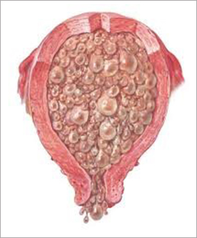 Molar pregnancy / Trophoblastic disease